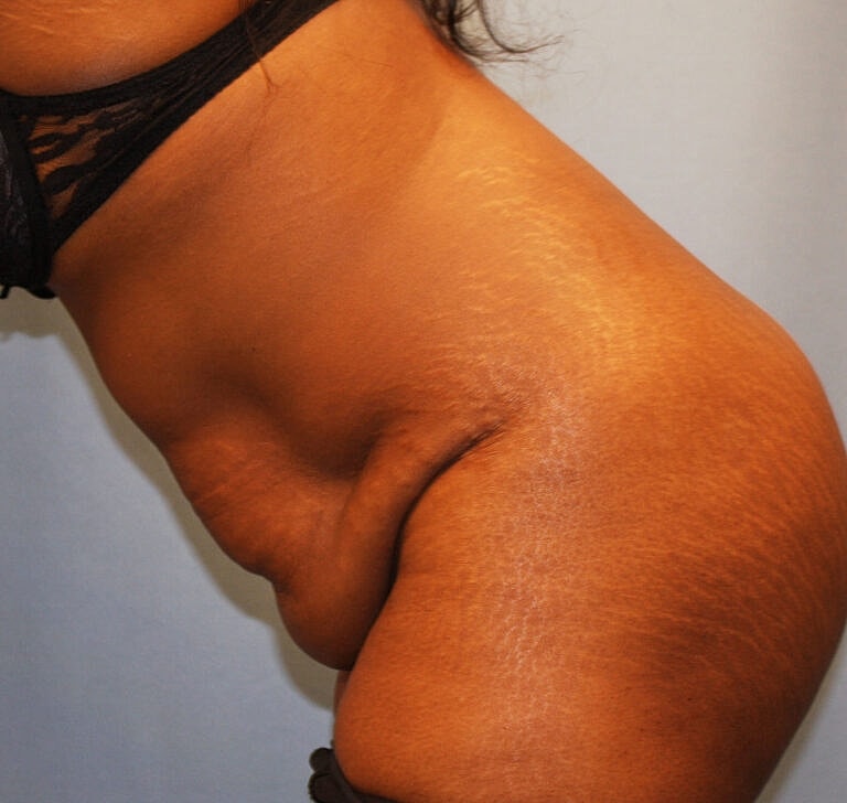 Abdominoplasty Tummy Tuck Before & After