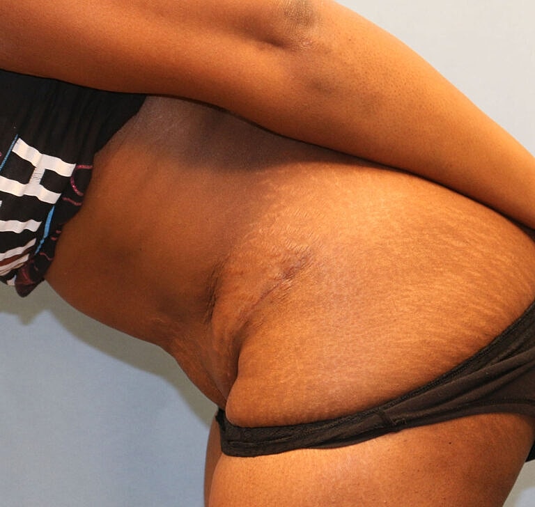 Abdominoplasty Tummy Tuck Before & After