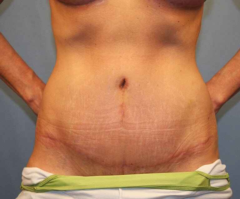 Abdominoplasty Tummy Tuck Before & After