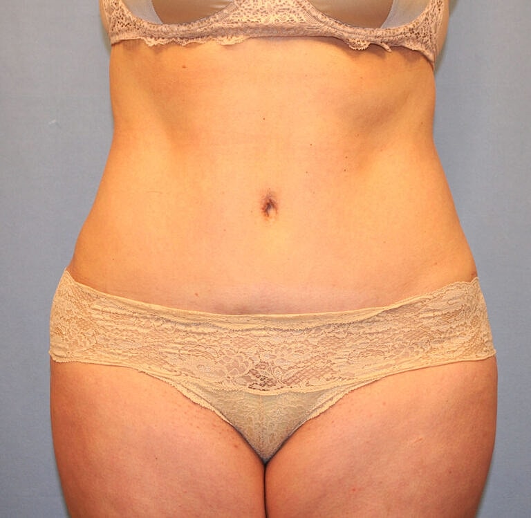 Abdominoplasty Tummy Tuck Before & After