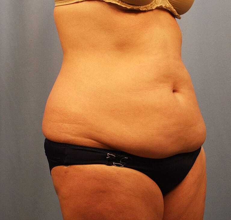 Abdominoplasty Tummy Tuck Before & After