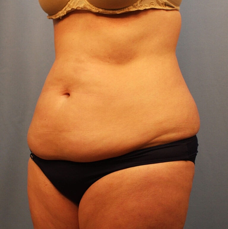 Abdominoplasty Tummy Tuck Before & After