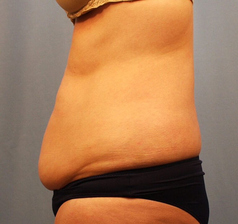 Abdominoplasty Tummy Tuck Before & After