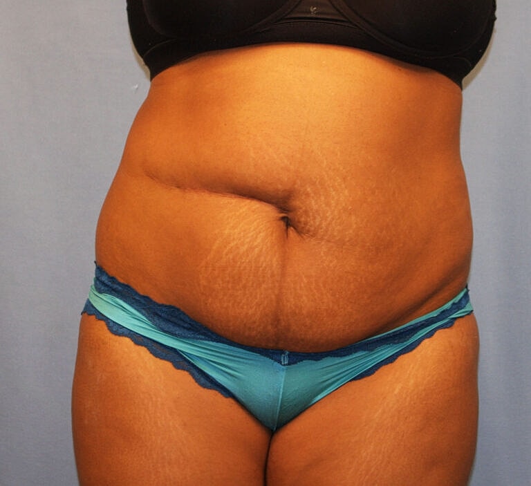 Abdominoplasty Tummy Tuck Before & After