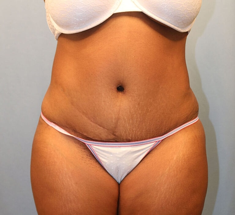 Abdominoplasty Tummy Tuck Before & After