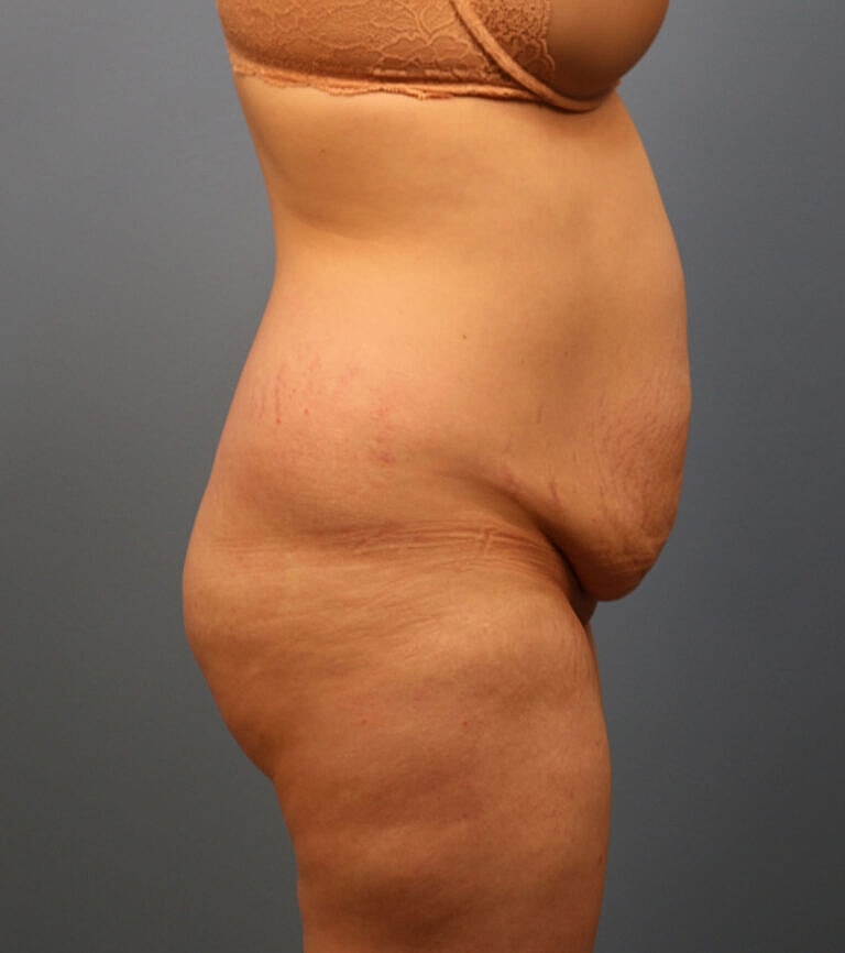 Abdominoplasty Tummy Tuck Before & After