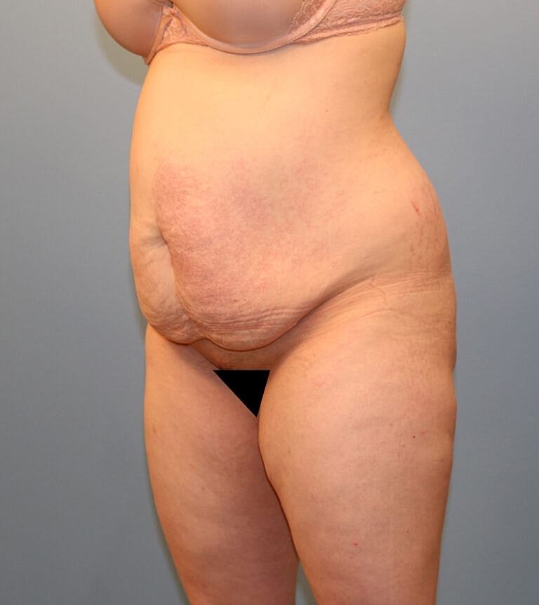 Abdominoplasty Tummy Tuck Before & After