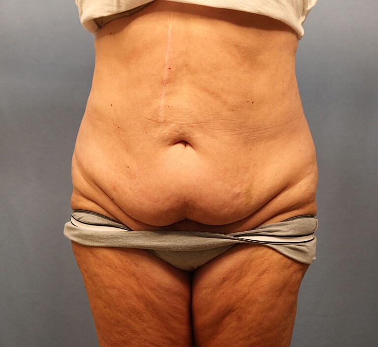 Abdominoplasty Tummy Tuck Before & After