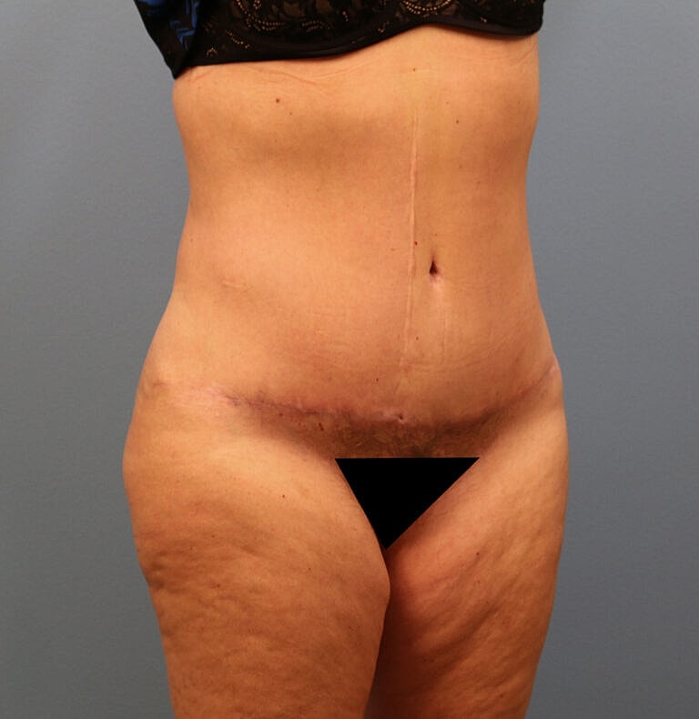 Abdominoplasty Tummy Tuck Before & After