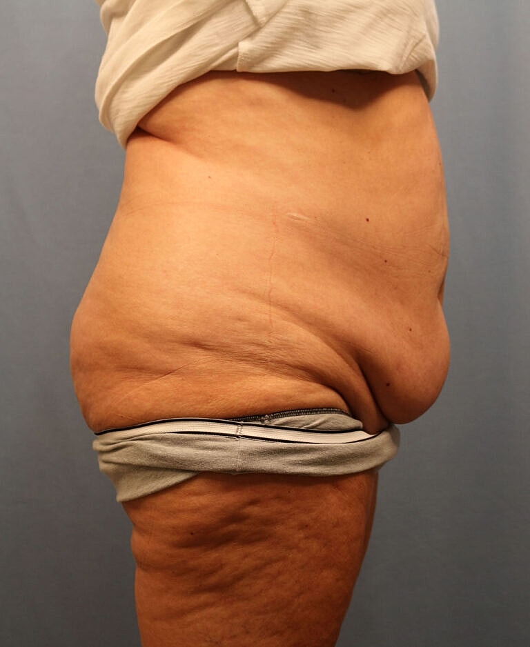 Abdominoplasty Tummy Tuck Before & After