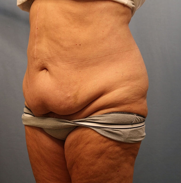 Abdominoplasty Tummy Tuck Before & After