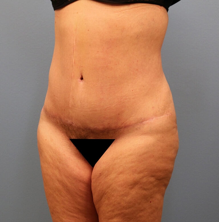 Abdominoplasty Tummy Tuck Before & After
