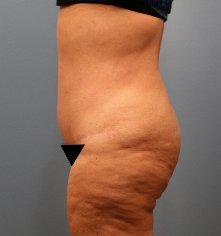 Abdominoplasty Tummy Tuck Before & After