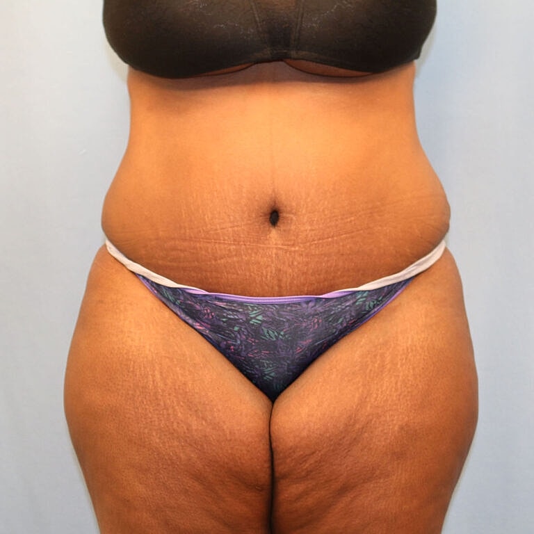 Abdominoplasty Tummy Tuck Before & After