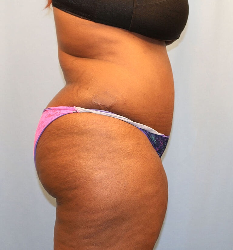 Abdominoplasty Tummy Tuck Before & After