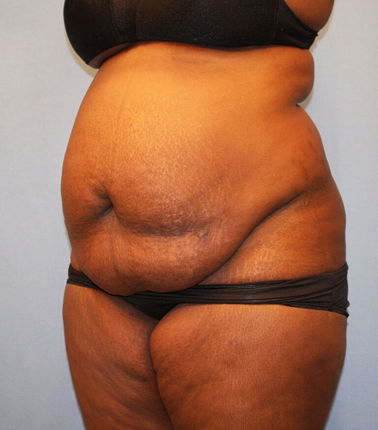 Abdominoplasty Tummy Tuck Before & After