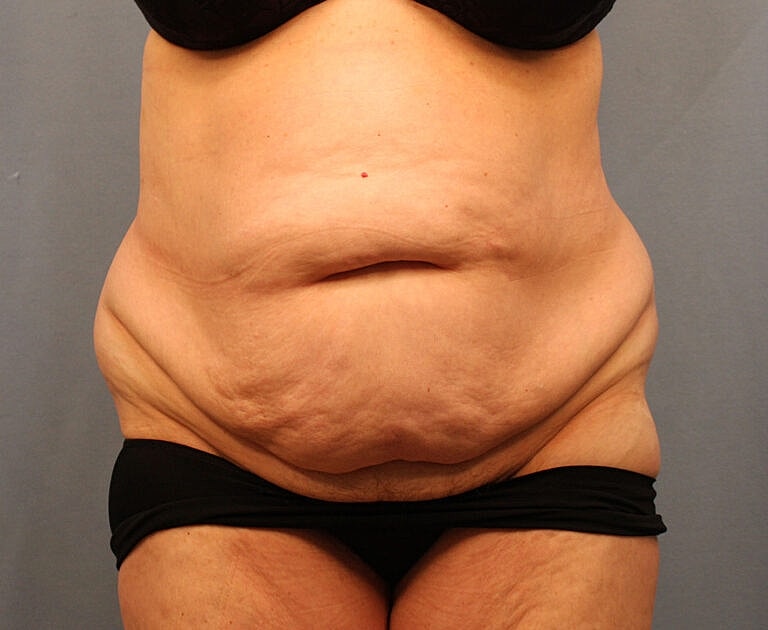 Abdominoplasty Tummy Tuck Before & After