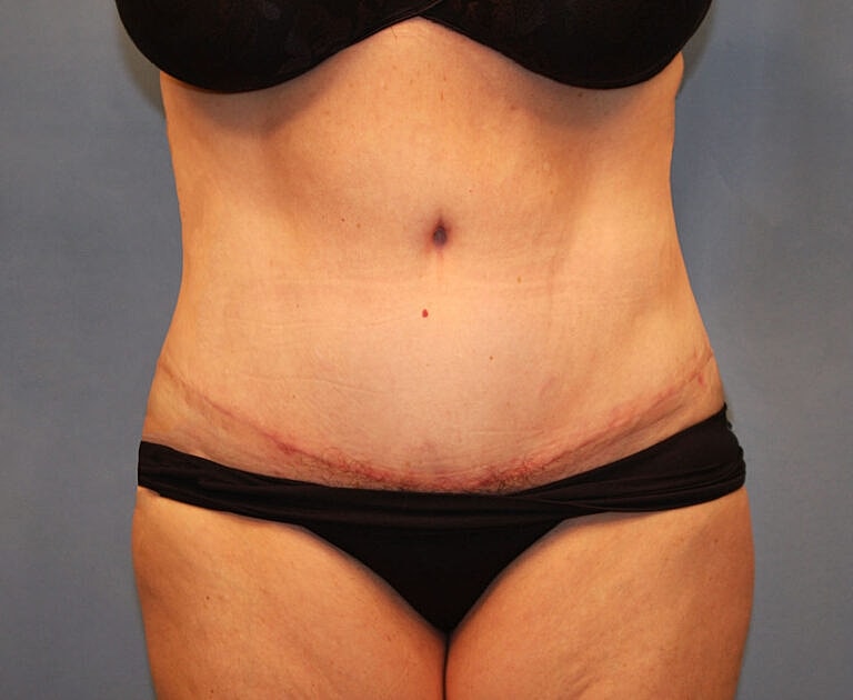Abdominoplasty Tummy Tuck Before & After