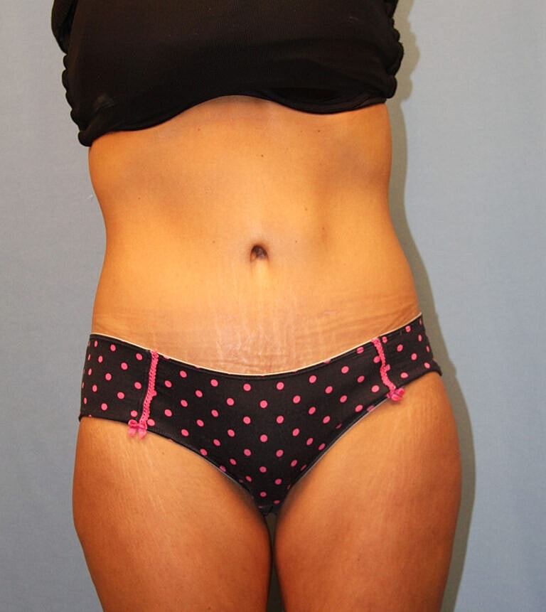 Abdominoplasty Tummy Tuck Before & After