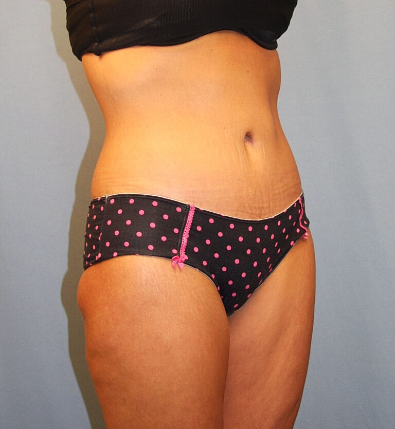 Abdominoplasty Tummy Tuck Before & After