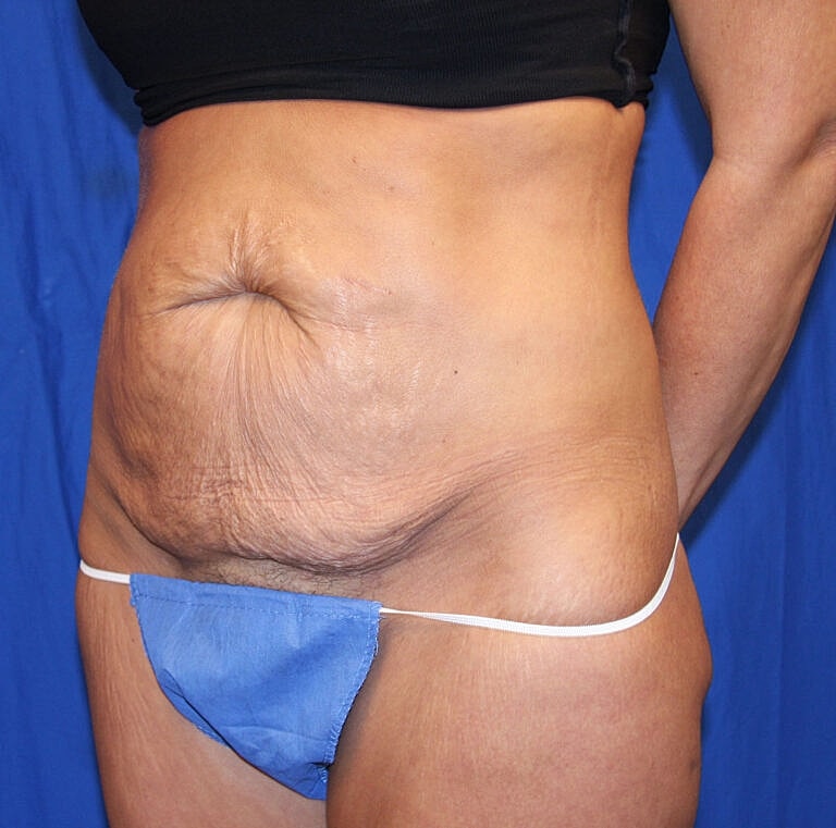 Abdominoplasty Tummy Tuck Before & After