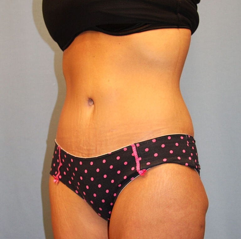 Abdominoplasty Tummy Tuck Before & After