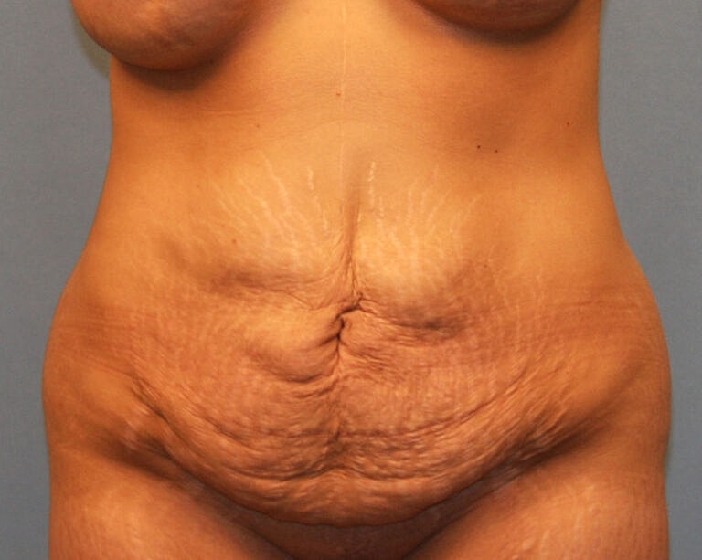 Abdominoplasty Tummy Tuck Before & After