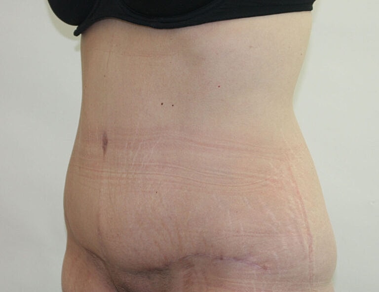 Abdominoplasty Tummy Tuck Before & After