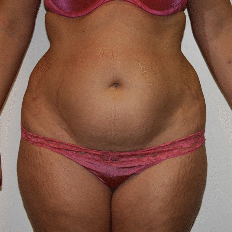 Abdominoplasty Tummy Tuck Before & After