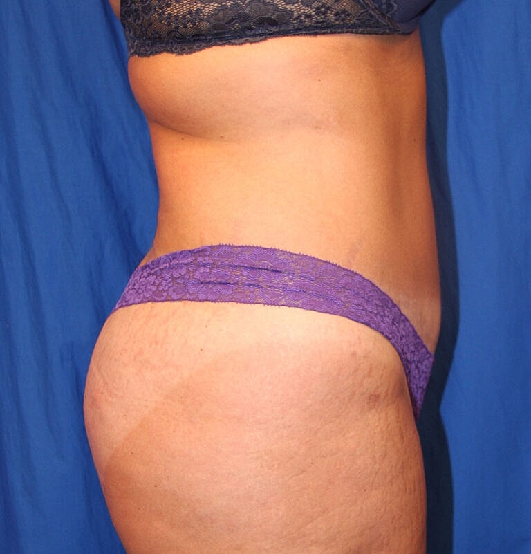 Abdominoplasty Tummy Tuck Before & After
