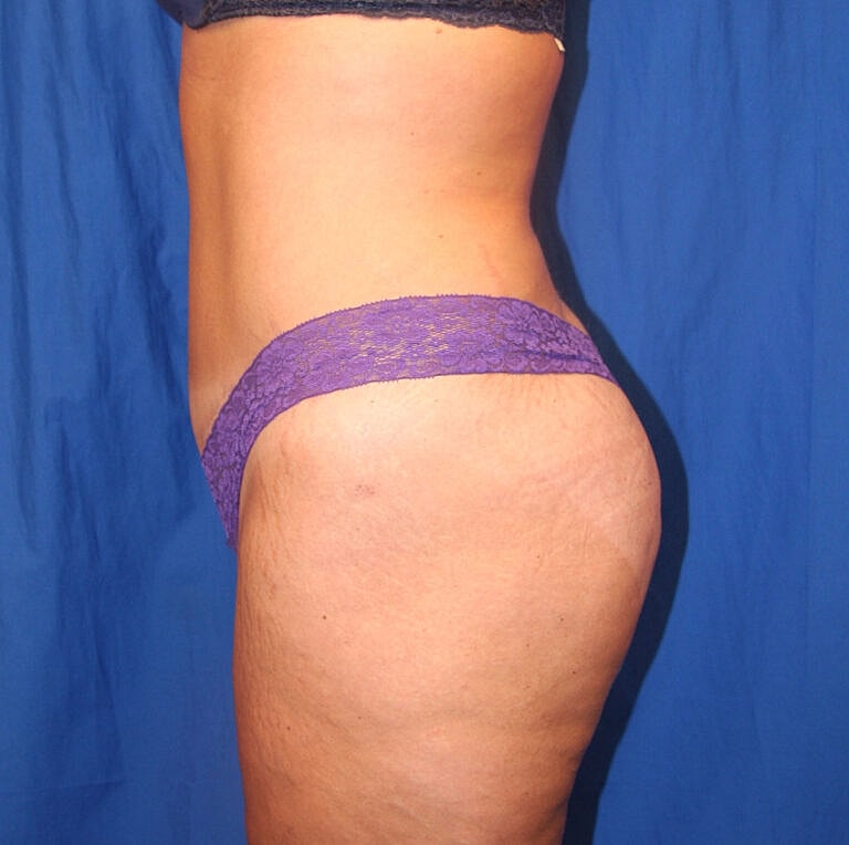 Abdominoplasty Tummy Tuck Before & After