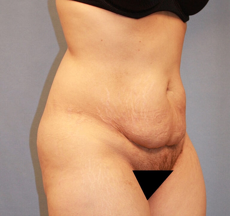 Abdominoplasty Tummy Tuck Before & After
