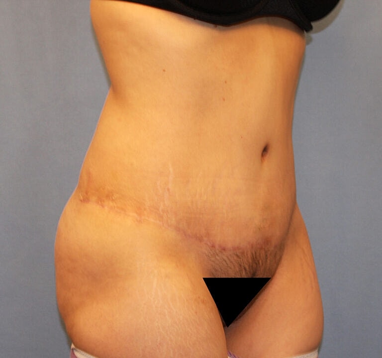 Abdominoplasty Tummy Tuck Before & After