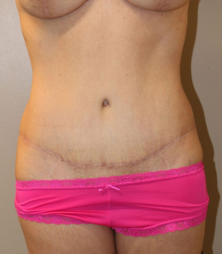 Abdominoplasty Tummy Tuck Before & After