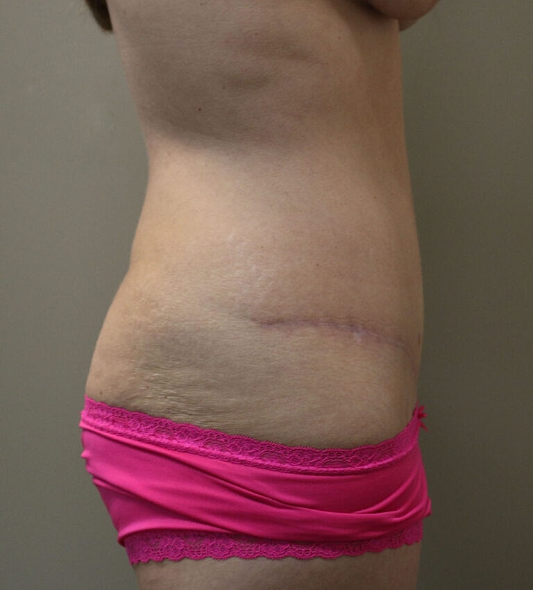 Abdominoplasty Tummy Tuck Before & After