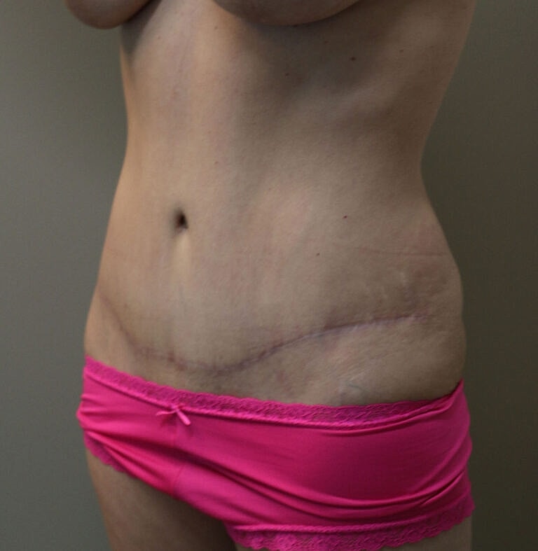 Abdominoplasty Tummy Tuck Before & After