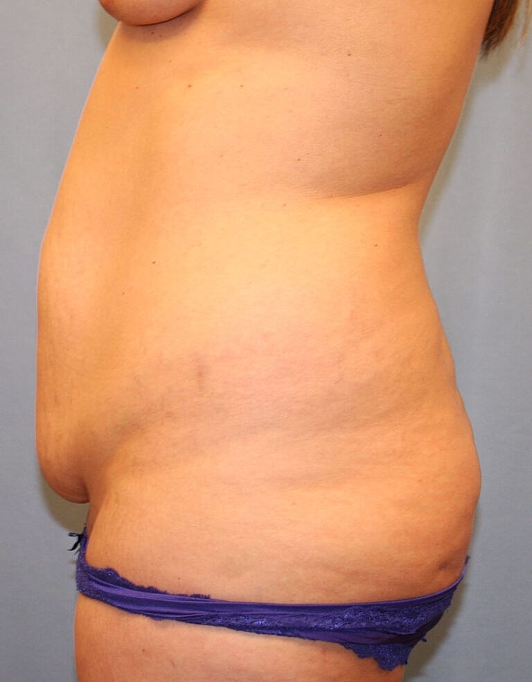 Abdominoplasty Tummy Tuck Before & After