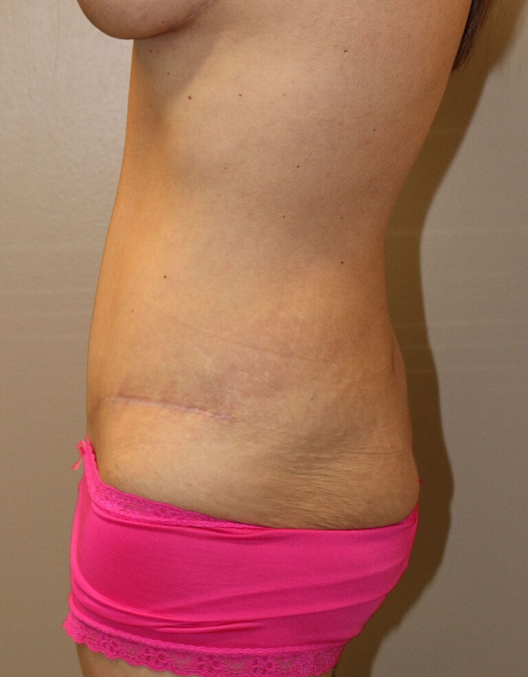 Abdominoplasty Tummy Tuck Before & After