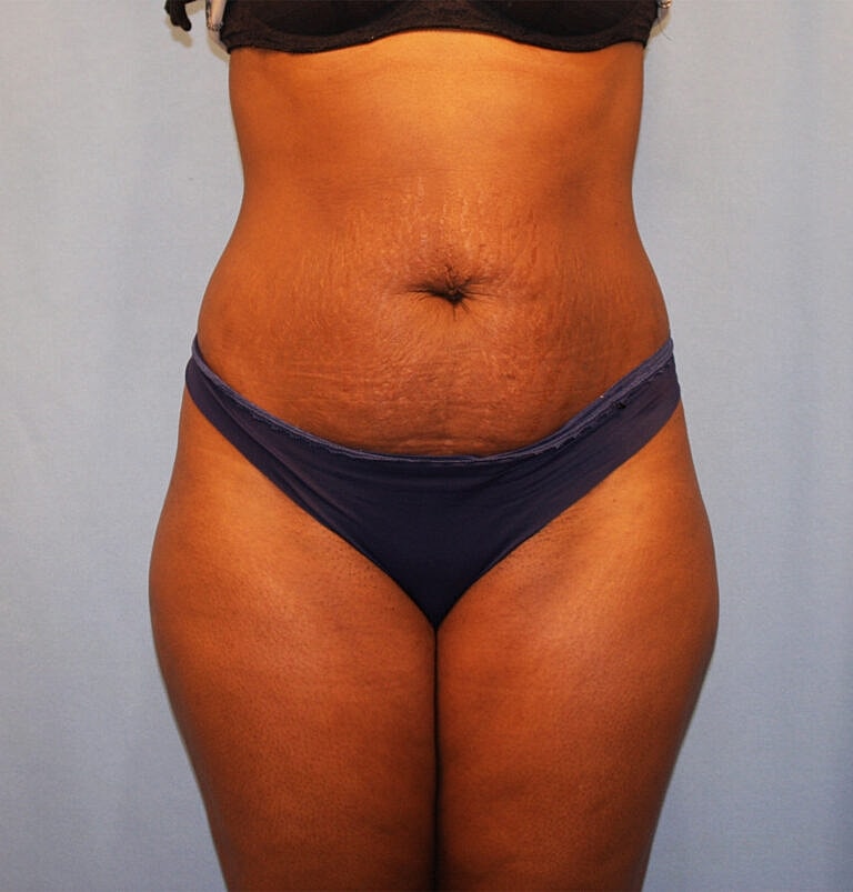 Abdominoplasty Tummy Tuck Before & After