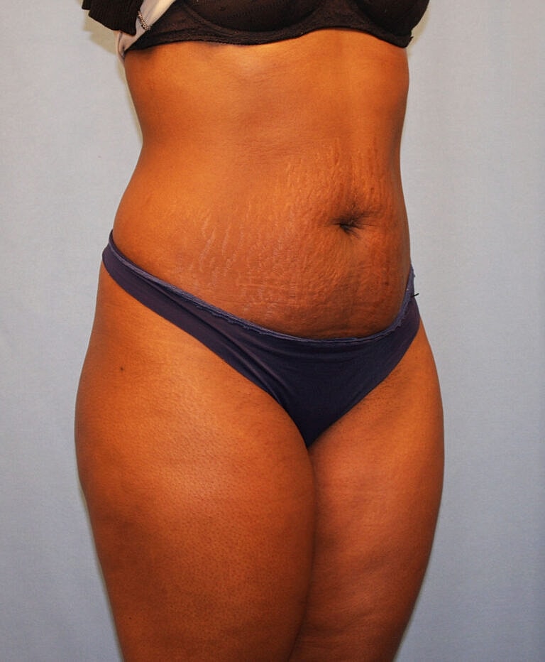 Abdominoplasty Tummy Tuck Before & After