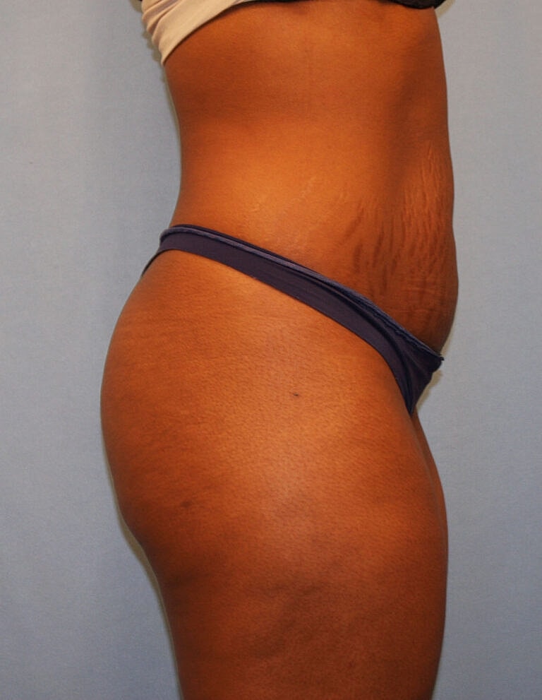 Abdominoplasty Tummy Tuck Before & After