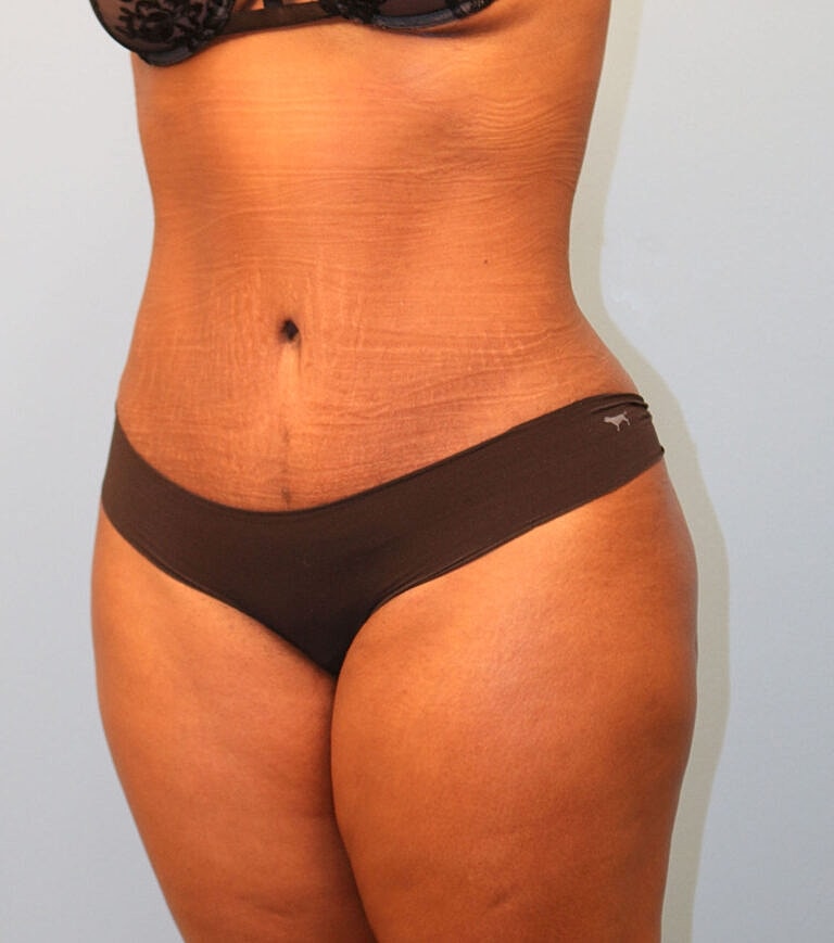 Abdominoplasty Tummy Tuck Before & After
