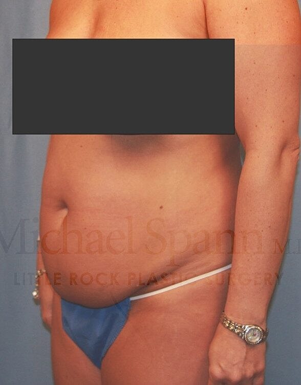 Abdominoplasty Tummy Tuck Before & After