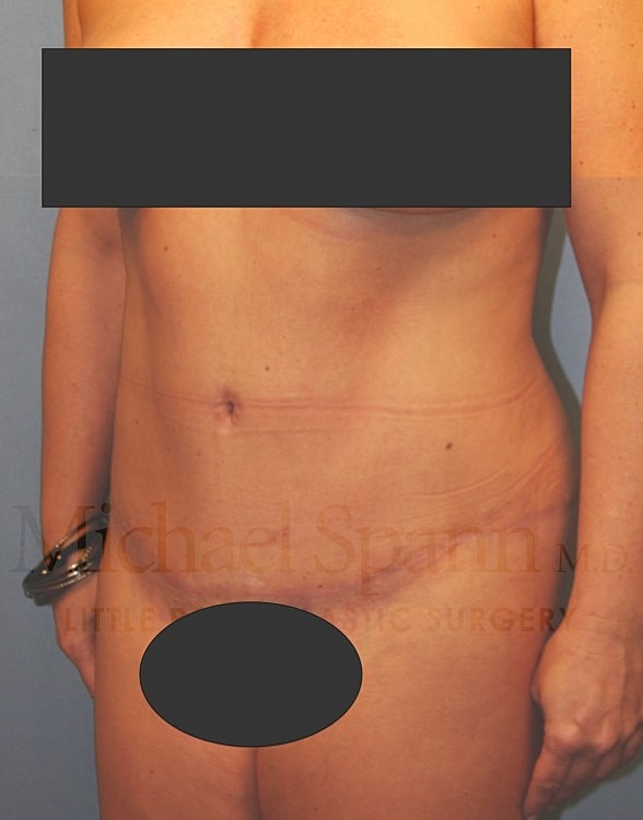 Abdominoplasty Tummy Tuck Before & After