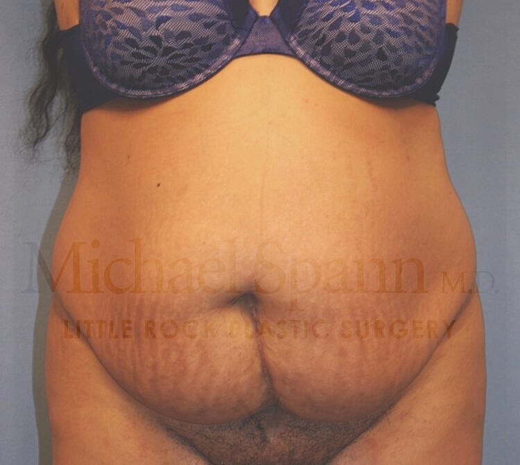 Abdominoplasty Tummy Tuck Before & After