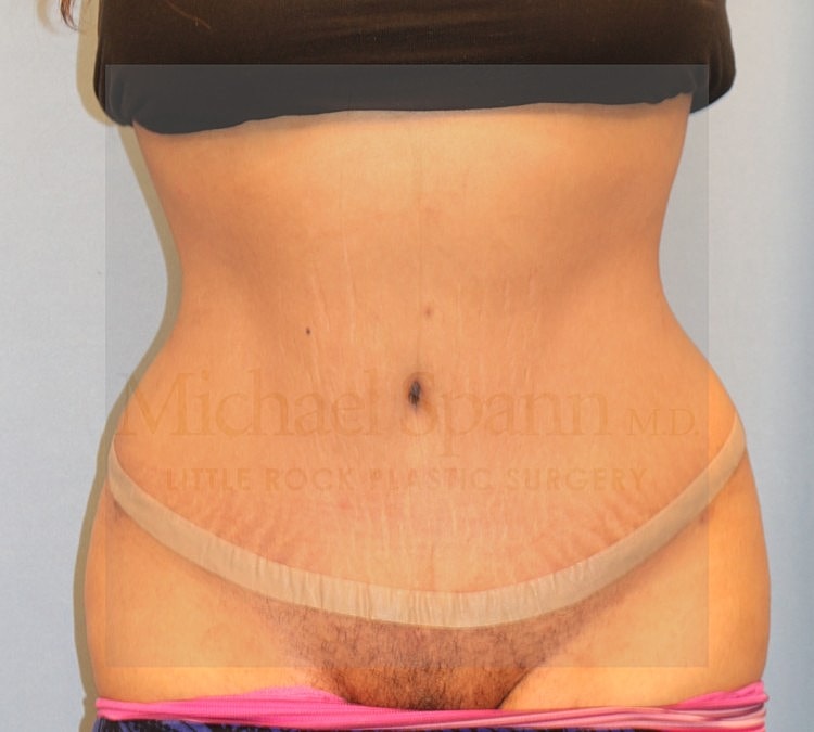 Abdominoplasty Tummy Tuck Before & After