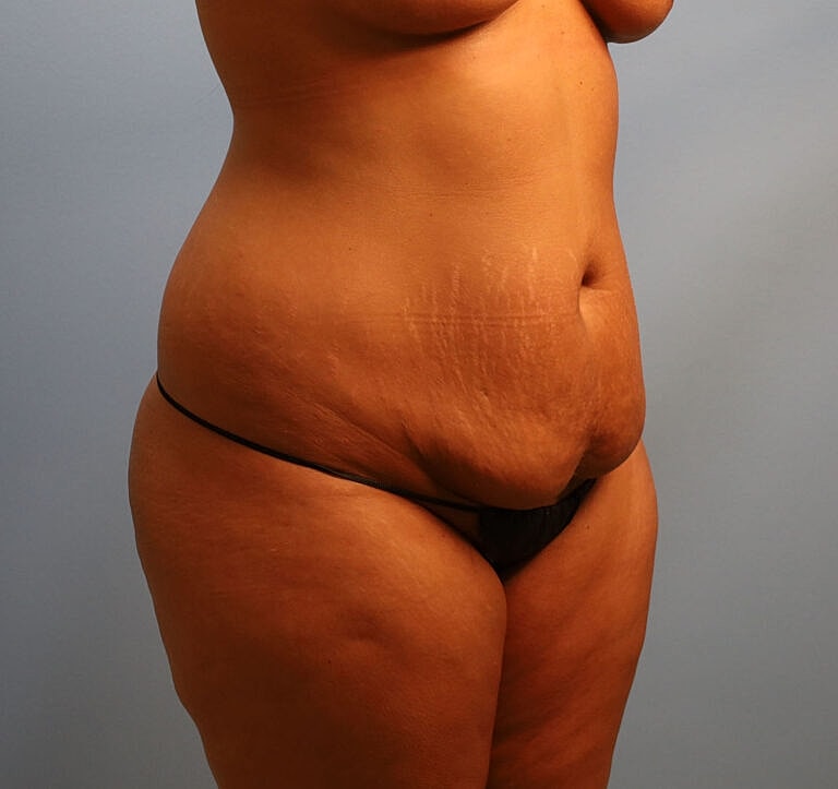 Abdominoplasty Tummy Tuck Before & After