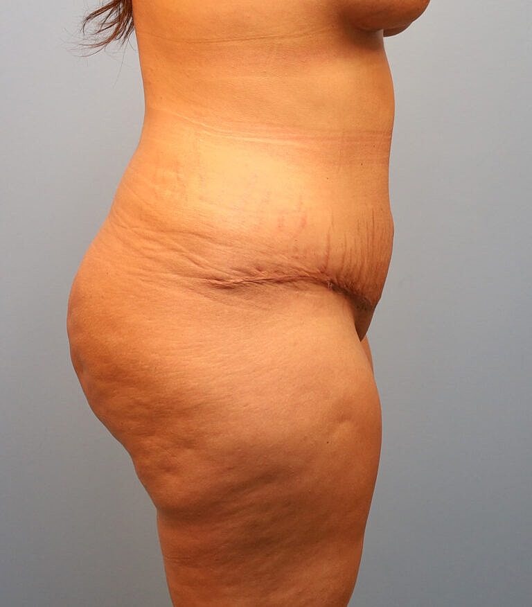 Abdominoplasty Tummy Tuck Before & After