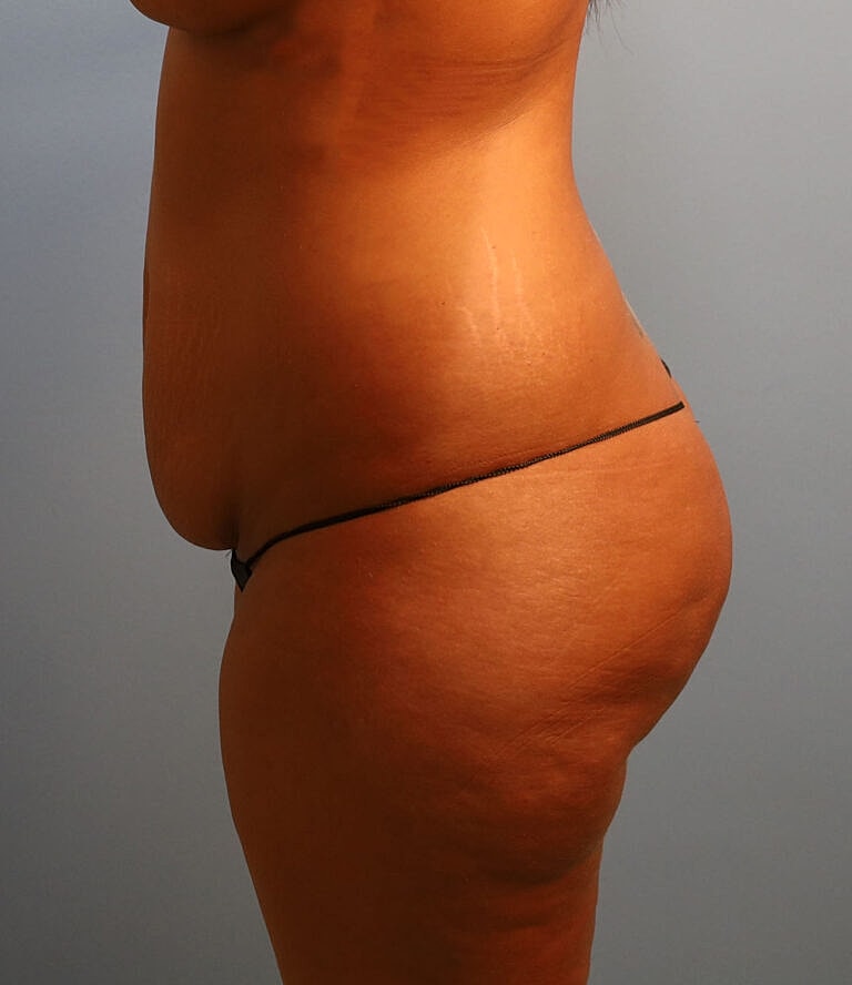 Abdominoplasty Tummy Tuck Before & After