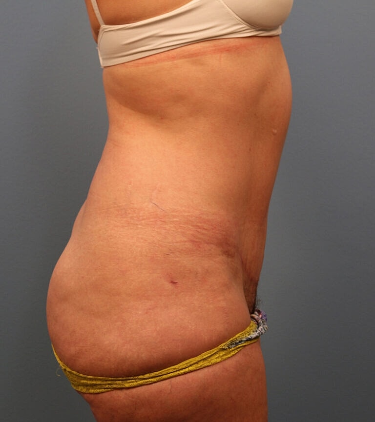Abdominoplasty Tummy Tuck Before & After